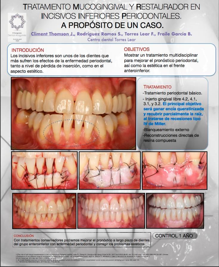 póster premio v congreso dental aragonés