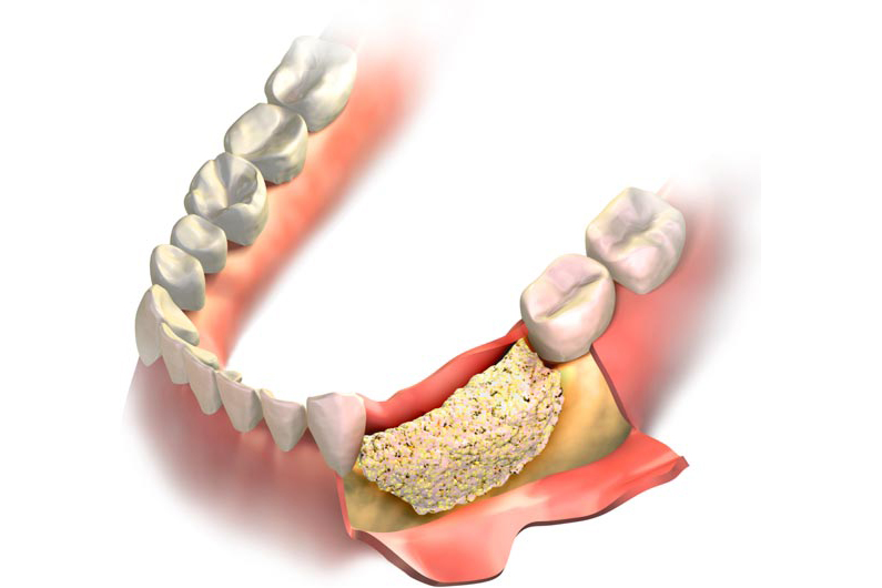 cómo evitar la pérdida de hueso después de una extracción dental