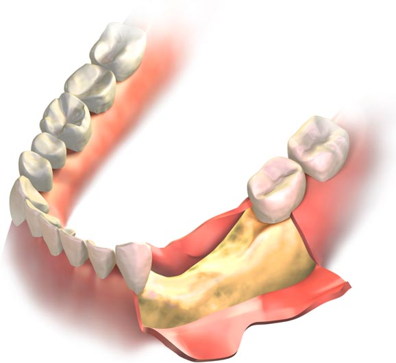 Cómo evitar la pérdida de hueso después de una extracción dental ultimos avances en preservacion alveolar previa a implantes dentales