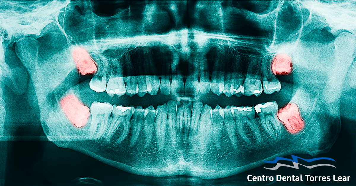 cavidad Disparates Prescribir Cuándo hay que quitar las muelas del juicio? | Clínica Dental en Zaragoza |  Centro Dental Torres