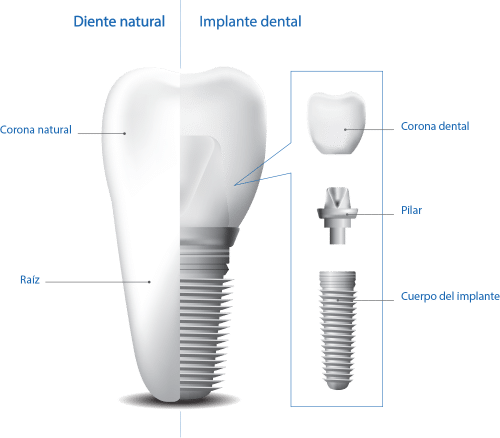 Imagen comparativa entre un diente natural  y un implante dental
