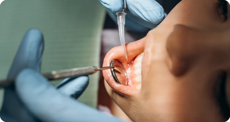 carillas dentales zaragoza