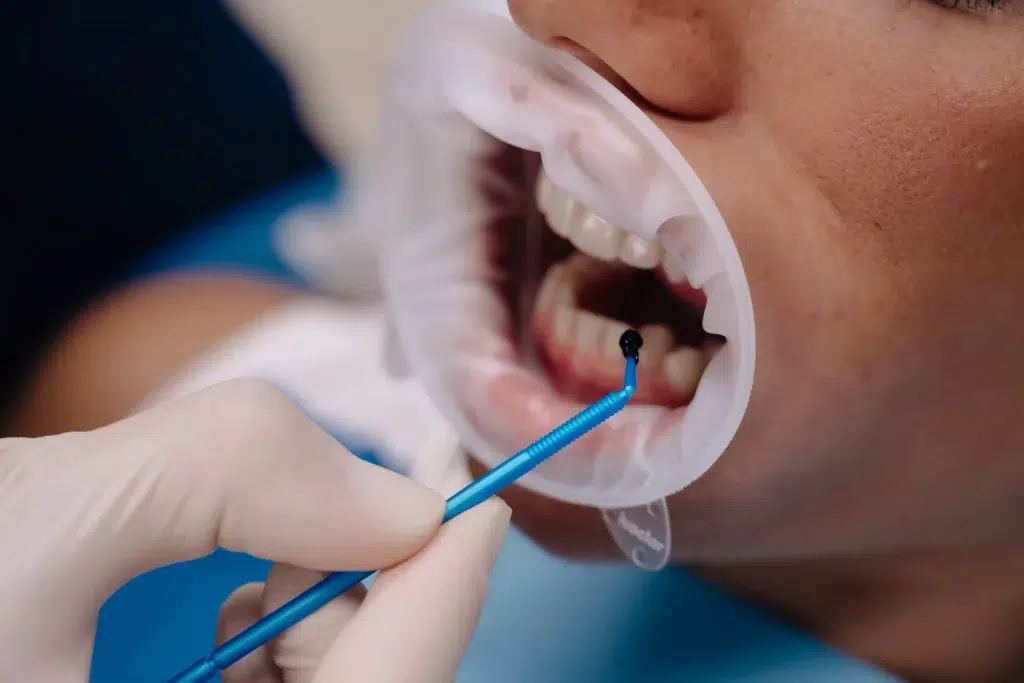 Gingivitis tratamiento gingivitis zaragoza