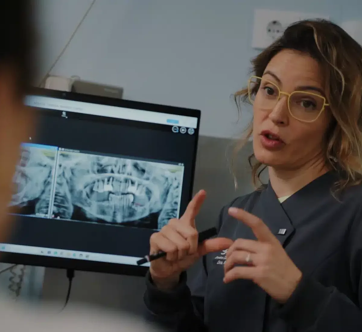 implantes dentales sin hueso